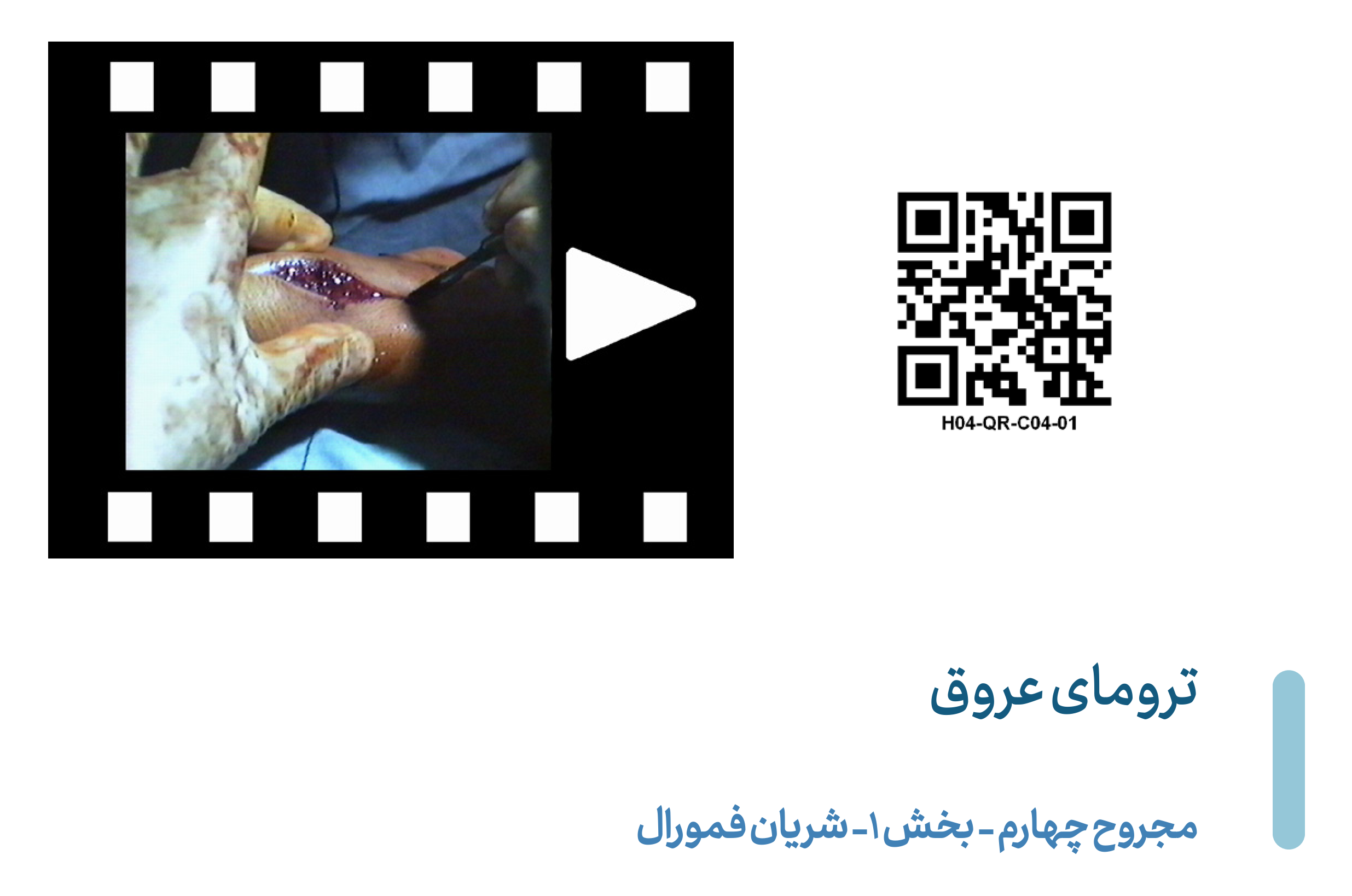 Femoral-V04-P1