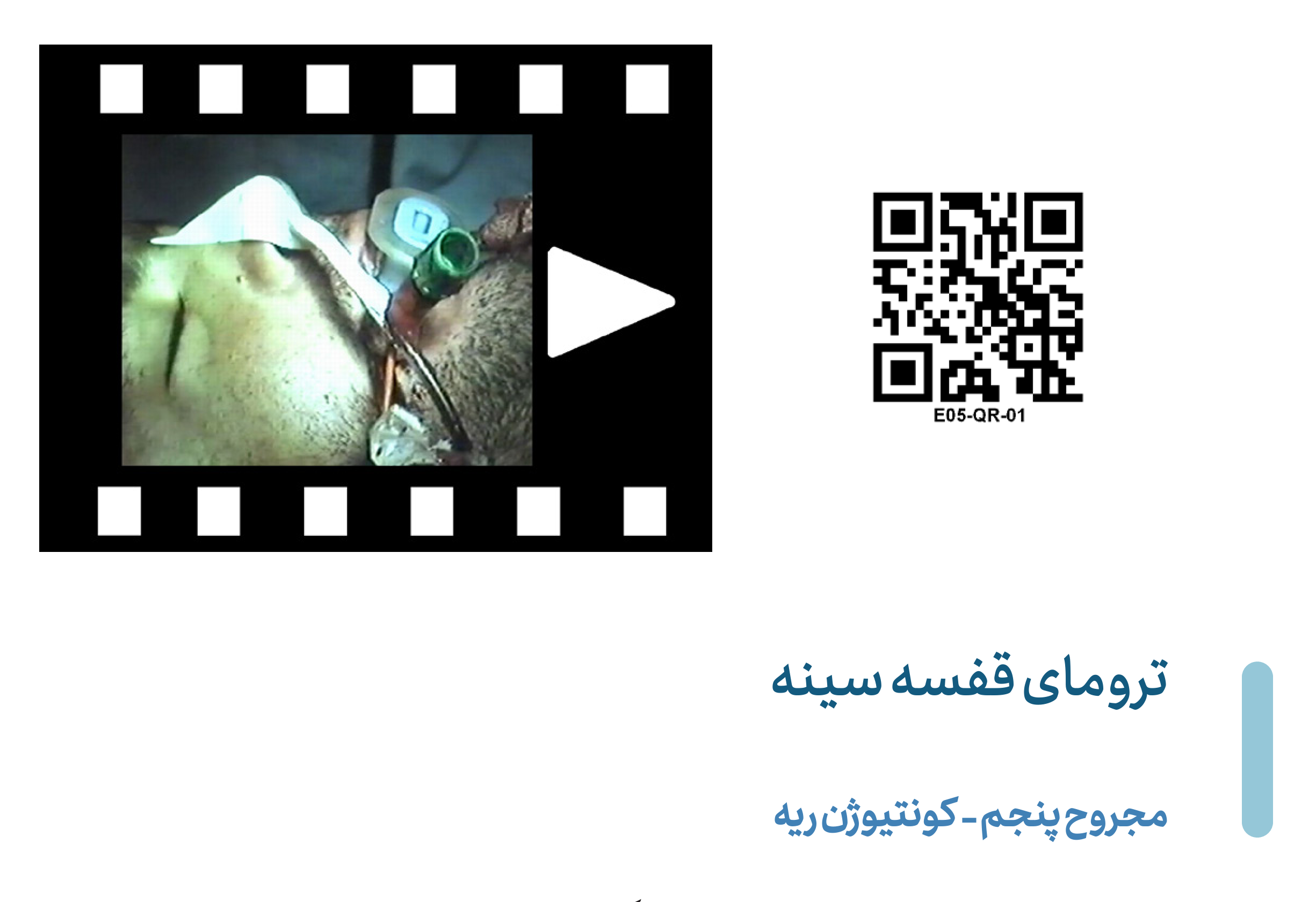 Pulmonary_contusion 